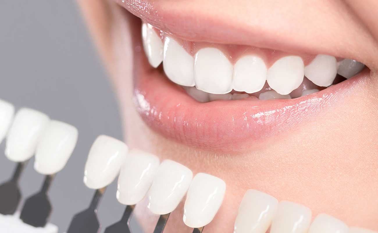 Teeth whitening treatment in Malaysia to achieve a brighter Smile and a Confident One